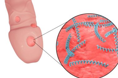 139- Solution pour Guérir la Syphilis. Un Traitement Naturel Pour Syphilis