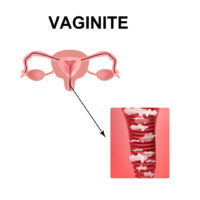 Mycoses et Vaginite Traitement naturel Vaginite