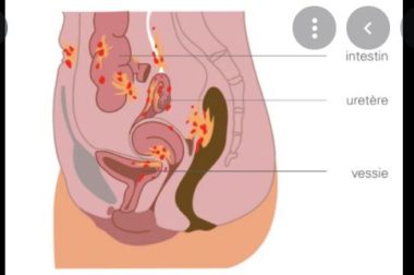 068-Endométriose Recettes Naturelles Pour Endométriose