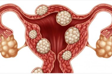 080- Fibrome de l’Utérus Traitement Naturel Pour le Fibrome Utérin