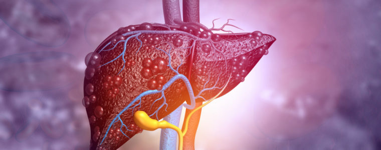 Hépatite B Traitement Naturel et Efficace. Synthèse Causes Symptômes