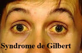 Soigner Naturellement Syndrome de Gilbert