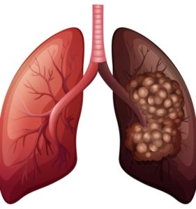 Cancer des poumons Remède Naturel