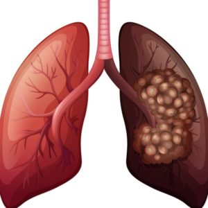 Cancer des poumons Remède Naturel