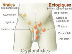 Symptômes et Complication Cryptorchidie 