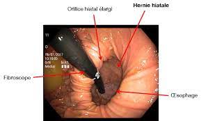 hernie hiatale Traitement Naturel est une protrusion anormale. Ainsi d'une portion de l'estomac à travers le diaphragme