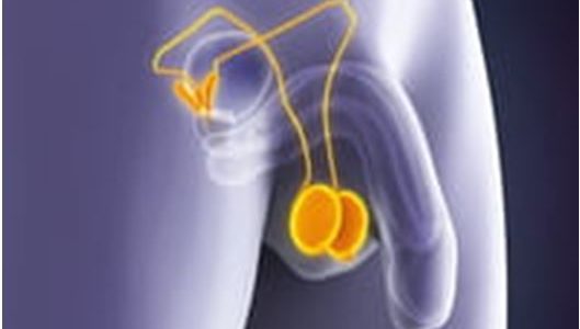 Hydrocèle : Comment Soigner Hydrocèle du Testicule?