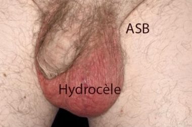 140-Guérir Une Hydrocèle : Comment Soigner Une Hydrocèle?