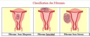 Mon Fibrome a Disparu: Classification des Fibromes