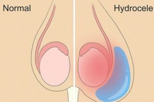 Hydrocèle : Causes Symptômes Traitements Hydrocèle Vaginale