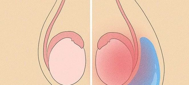 Hydrocèle : Causes Symptômes Traitements Hydrocèle Vaginale
