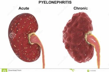 126-Pyélonéphrite Connaître la Pyélonéphrite pour un Traitement naturel