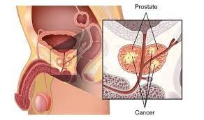 Traitement naturel cancer prostate