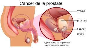 Remède naturel Cancer prostate