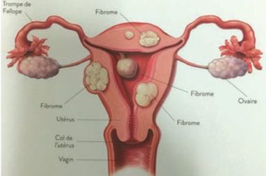 231-Fibromes et Traitements : Comment Soigne-t-on les fibromes?