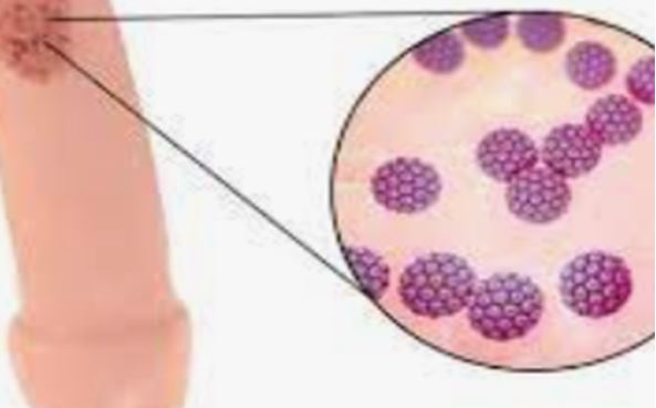 Verrues Génitales Traitement Naturel Condylome Papillomavirus