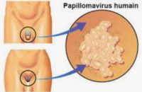 Condylome Traitement Naturel Contre Papillomavirus
