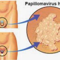 Condylome Traitement Naturel Contre Papillomavirus