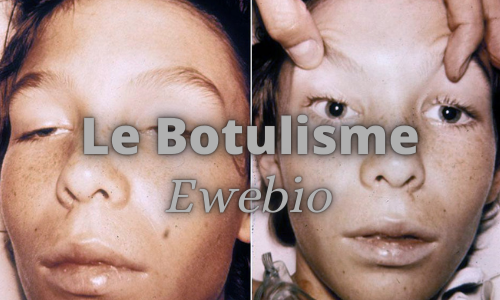 comment traiter Le botulisme naturellement?