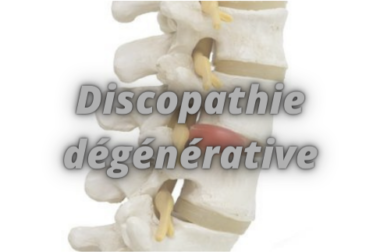 265-Discopathie dégénérative : Causes Symptômes et Traitement Naturel