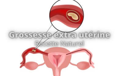 267-Qu’est-ce qu’une grossesse extra-utérine ? Possibilité de Traitement