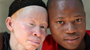 Connaître L'albinisme et Soigner