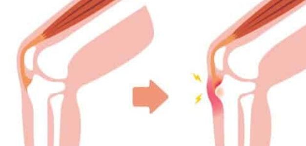 Osgood Schlatter : Comment Soigner Osgood Schlatter ?