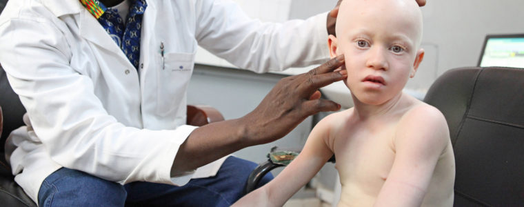 Connaître L'albinisme et Soigner