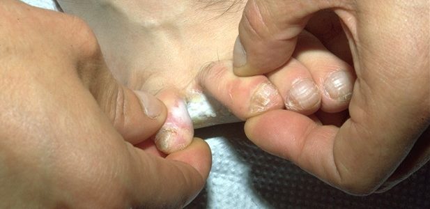 Remèdes naturel pieds d'athlète