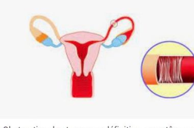 344- Obstruction Tubaire: Comment débloquer les trompes de Fallope?