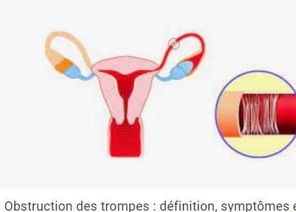 Obstruction Tubaire: Comment débloquer les trompes de Fallope?