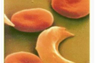 341- Différentes Formes de Drépanocytose : Traitement Naturel Drépanocytose