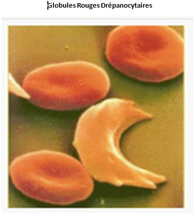 341- Différentes Formes de Drépanocytose : Traitement Naturel Drépanocytose