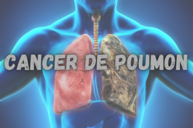 397-Solution Naturel Cancer des Poumons : Définition Causes Symptômes