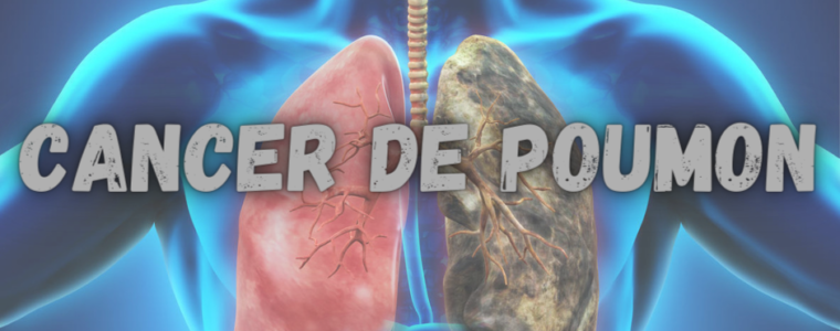 Solution Naturel Cancer de Poumon