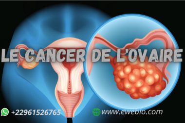518- Le Cancer de L’ovaire : Quel sont les Symptômes et Comment Soigner?