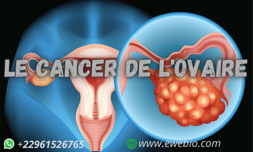 Comment Soigner Le Cancer de L'ovaire ?