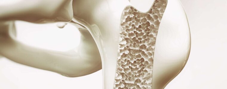 Thrombose Veineuse: Traitement Béninoise Avec Les Plantes