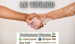 Les Informations sur le Vitiligo pour Soigner
