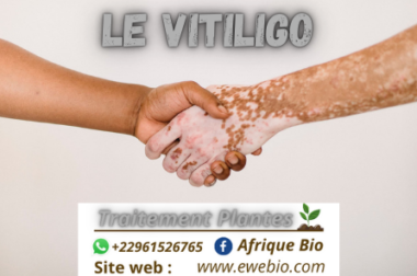 522- Le vitiligo : Tout savoir sur cette Affection de la Peau
