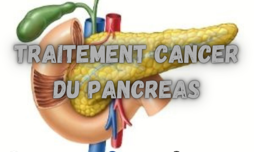 Comment Soigner le Cancer du Pancréas?
